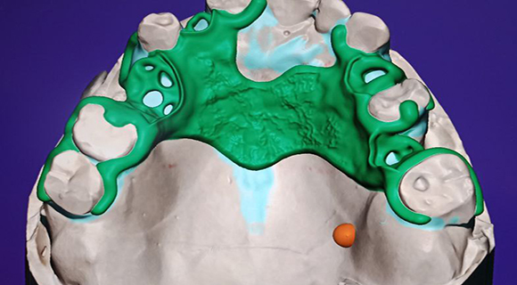 Съемные протезы